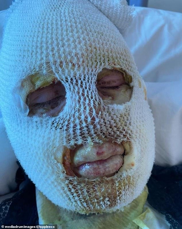 Dos primos enfrentan quemaduras y un amigo rociado con etanol después de que un calentador de mesa explotara en una bola de fuego en un pub, según escucha el tribunal