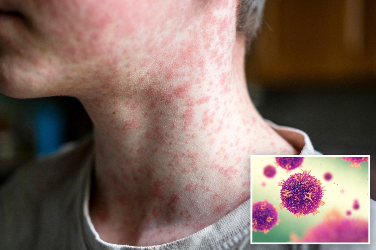 Cuarto caso de sarampión confirmado en el condado de Los Ángeles, se insta a la comunidad a tomar precauciones