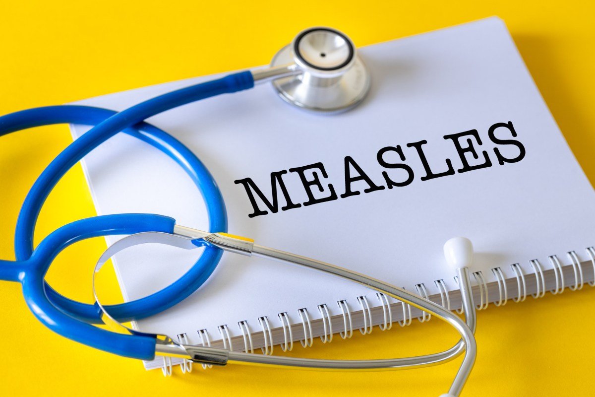 Mapa que muestra la prevalencia del sarampión en los Estados Unidos