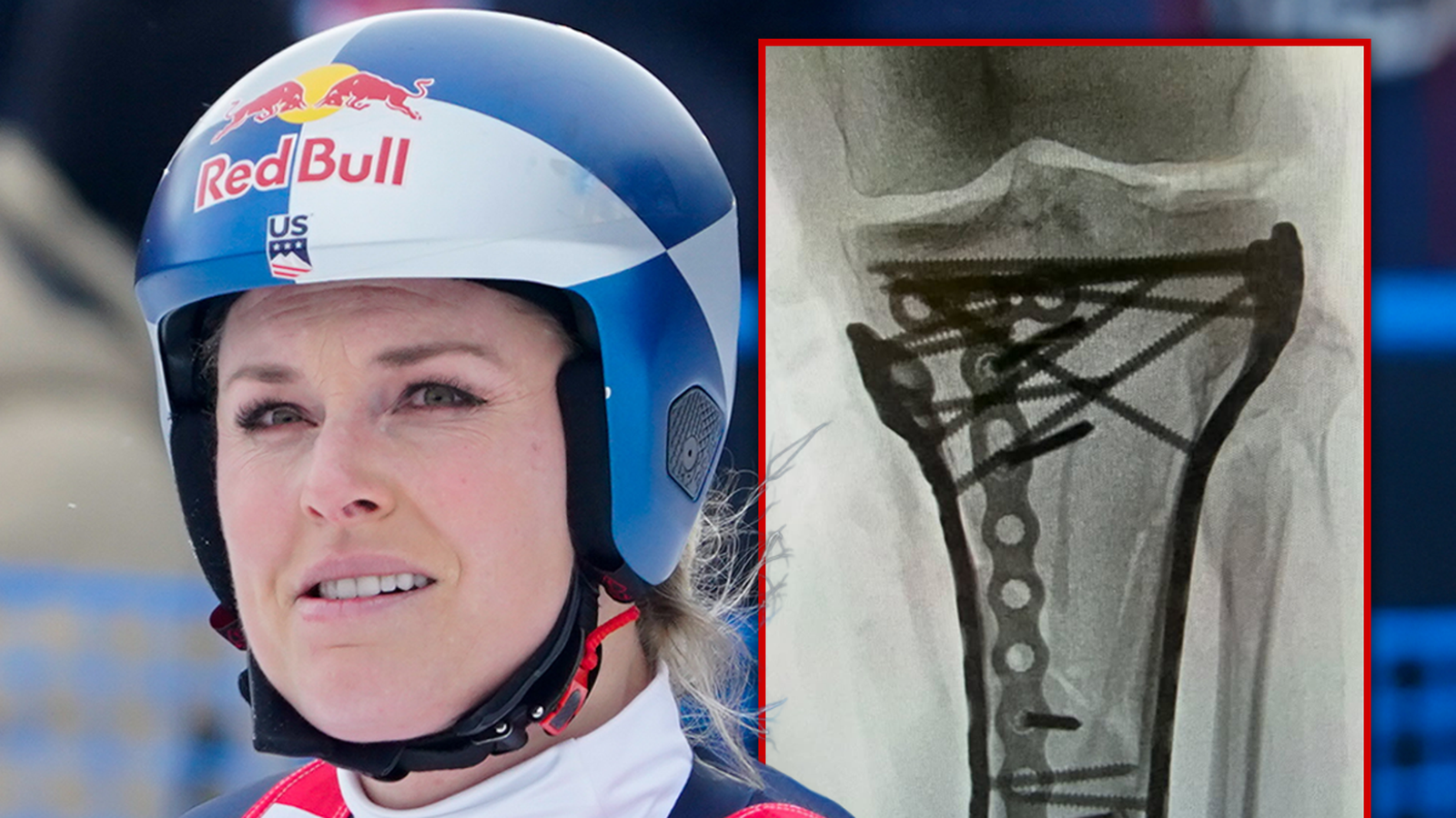 Lindsay Vonn está «peleando» en un hospital de EE. UU. tras una reciente cirugía