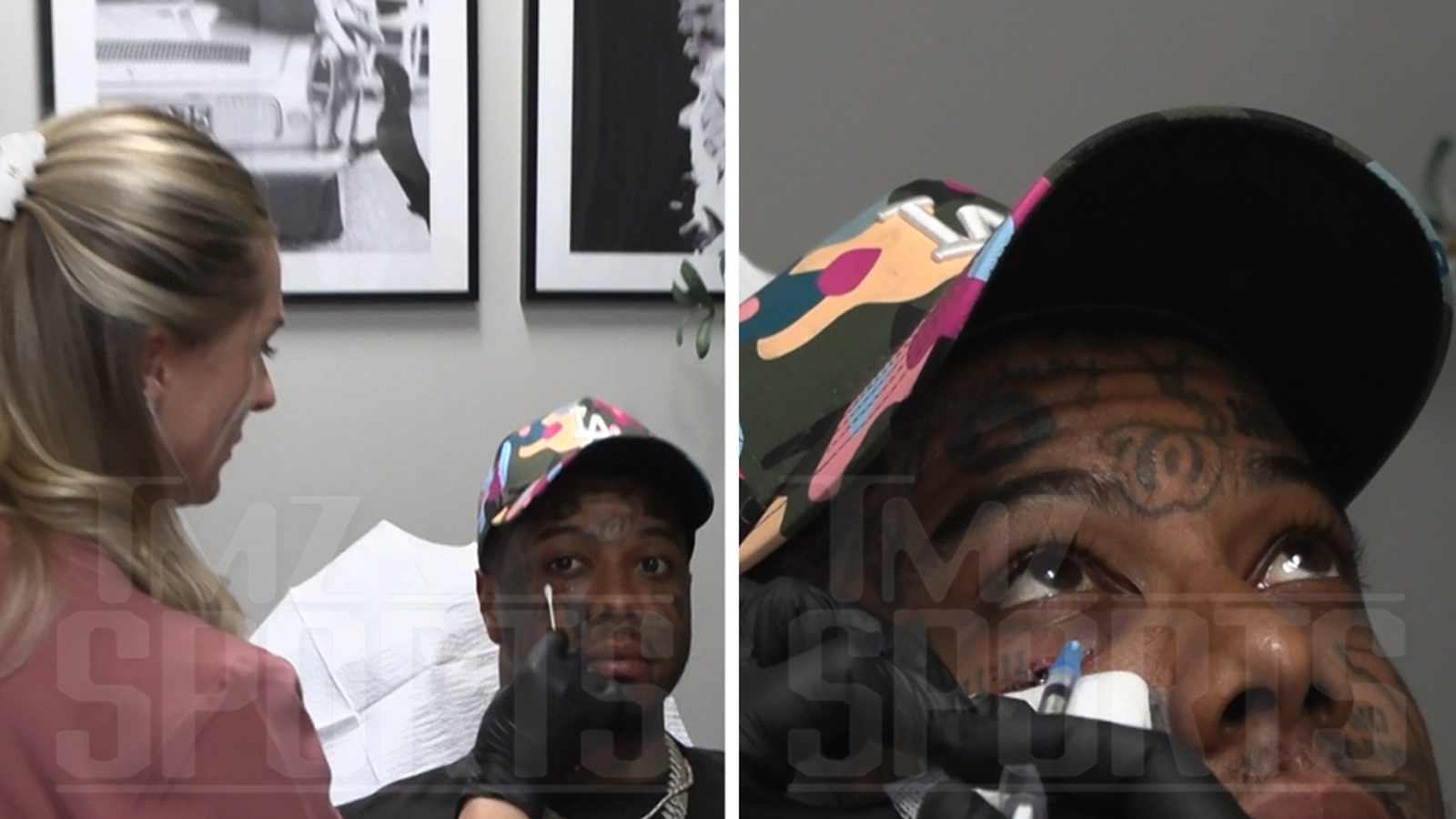 Se corrigió una lesión en la cara azul después de recibir un codazo en la cara durante una sesión de sparring.