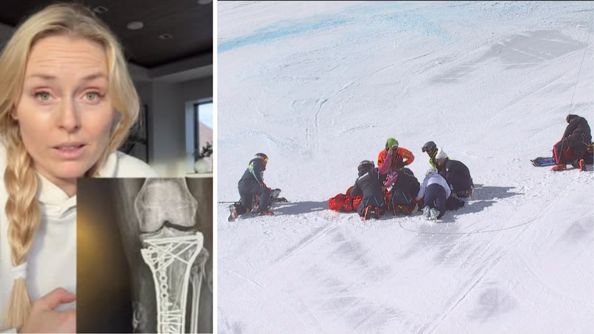 Lindsay Vonn dice que la cirugía salvó su pierna izquierda de la amputación