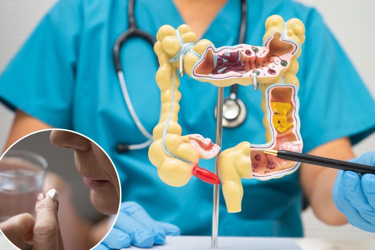 El ejercicio diario no ayuda a prevenir el cáncer colorrectal